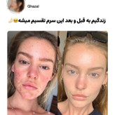 پوست خانمی قبل و بعد از استفاده از سرم حلزون کازرکس