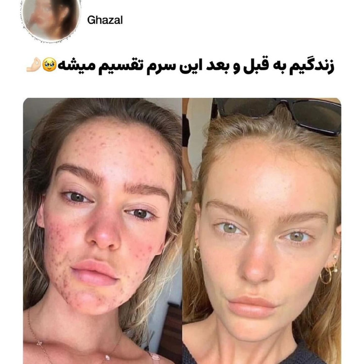 پوست خانمی قبل و بعد از استفاده از سرم حلزون کازرکس